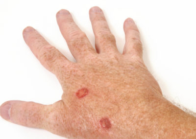 GP case study: Telederm
